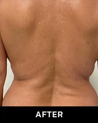 mcf-after morpheus body