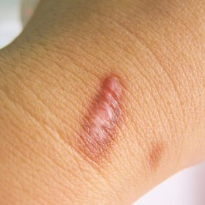 Scar on human burned skin from hot water scald, selective focus