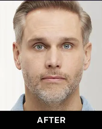 after botox after botox