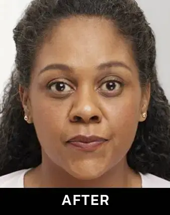 after botox after botox