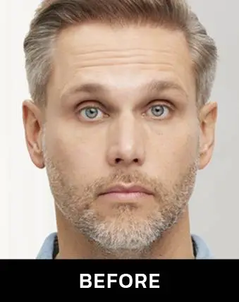 before botox before botox